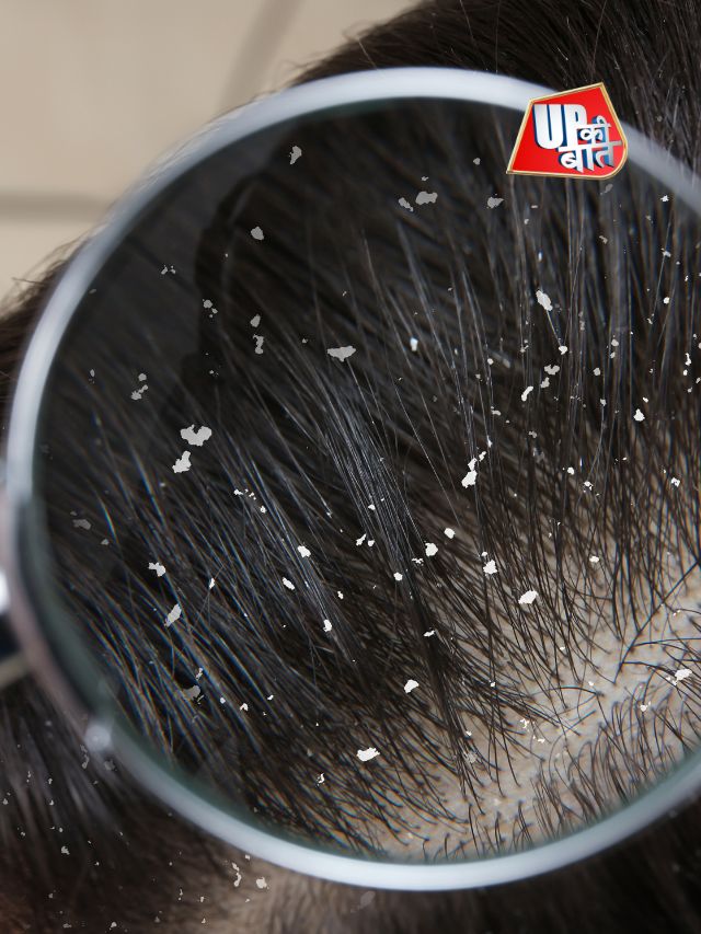 Dandruff को हटाने में एलोवेरा ऐसे सहायक